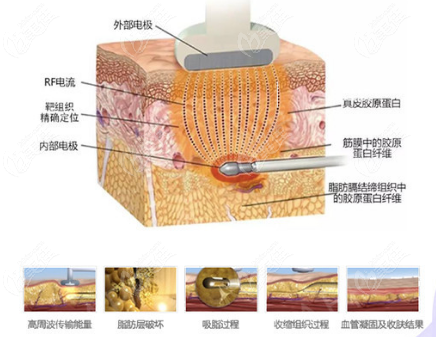 黄金微雕吸脂多久才能不肿-黄金微雕吸脂需要打肿胀液吗