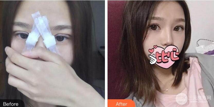 安医大附一院整形美容中心瘦脸-安徽医科大学第一附属医院整形美容