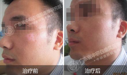 美白产品过度对白癜风有用吗-一直用美白产品会导致什么后果