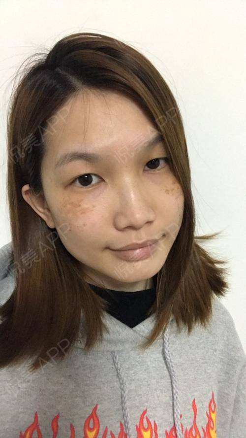 激光美容后需要多久才能恢复-激光美容后多久能恢复原来的皮肤