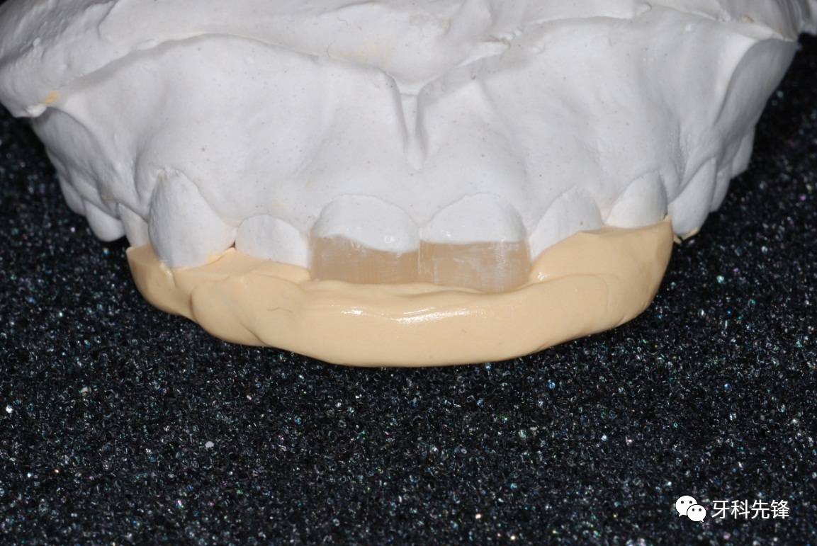 前牙硅胶导板美容修复-前牙树脂修复硅胶导板怎么制作